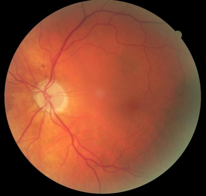 CASE: NON-ARTERITIC ANTERIOR ISCHEMIC OPTIC NEUROPATHY 72 yo Caucasian male presented with chronic NAION H/O: NAION occurred in right eye 13 years ago followed by a similar
