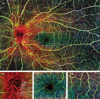 OPTICAL COHERENCE TOMOGRAPHY ANGIOGRAPHY (OCTA) Non-invasive imaging technology that allows in vivo visualization of the retinal and