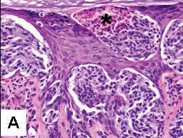 invasive melanoma with host reaction above