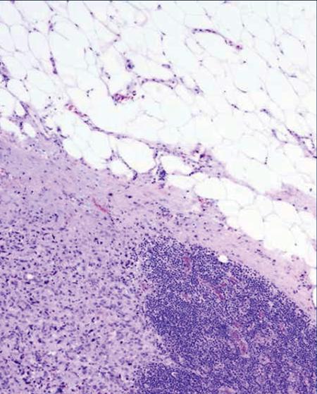 into adjacent tissues usually seen as microscopic extension of metatatic