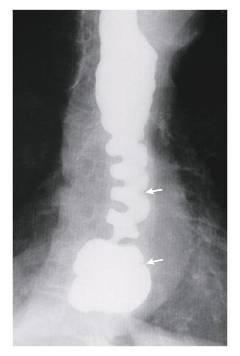 Diagnosis Barium Swallow: Radiographic findings variable from normal to severe