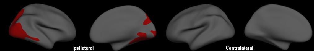 Challenge: Influence of Analysis Cortical Thickness: Freesurfer Technique: TLE-MTS IPSI CONTRA Gray Matter