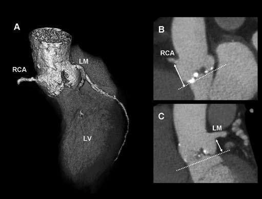 468 Chapter 28 Figure 4. Spatial relationship between the aortic valve annular plane and the ostia of the coronary artery assessed with MDCT.
