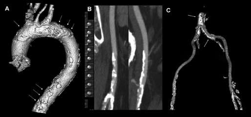 Transcatheter aortic valve implantation: role of multimodality cardiac imaging 469 Figure 5. Evaluation of aorta and peripheral arteries with MDCT.