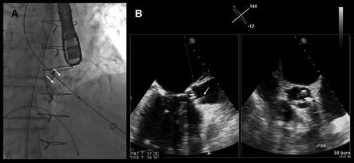 470 Chapter 28 Figure 6. Fluoroscopy and transesophageal echocardiography during TAVI procedure.