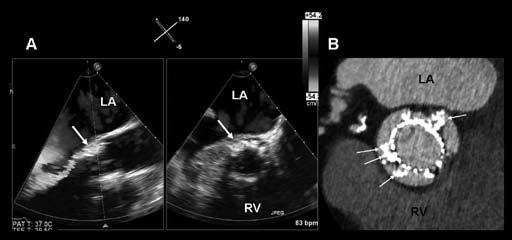 Transcatheter aortic valve implantation: role of multimodality cardiac imaging 471 Figure 7. Evaluation of function and deployment of the transcatheter valve.