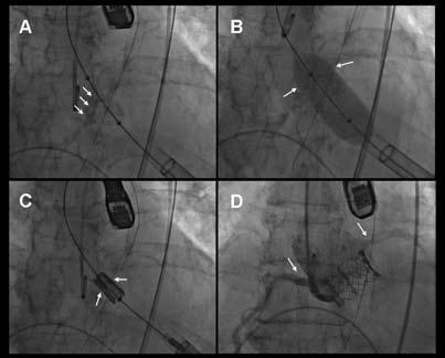 Transcatheter aortic valve implantation: role of multimodality cardiac imaging 463 by using the valvular calcium on fluoroscopy as reference landmarks, the location of the aortic cusps on
