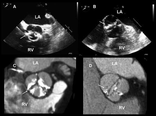466 Chapter 28 Figure 2. Assessment of aortic valvular anatomy and calcifications.