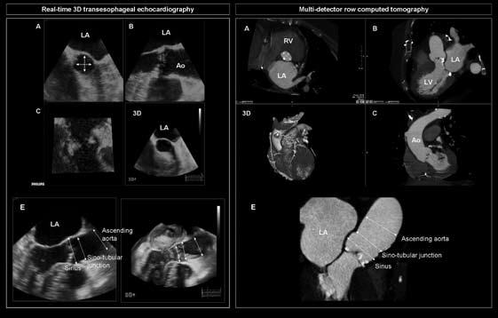 Transcatheter aortic valve implantation: role of multimodality cardiac imaging 467 Assessment of feasibility of TAVI procedures To assess the feasibility of TAVI, the following factors should be