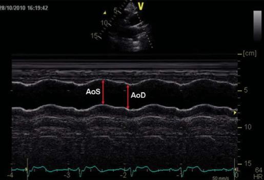 load (= proximal aortic stiffness) has a direct detrimental impact on LV function, BNP