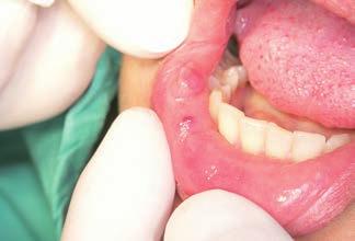 Case 1 Female patient aged 37 with mucosal