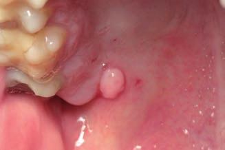 Case 2 Male patient aged 31 with mucosal
