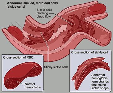 Autosomal Recessive Disorders Sickle Cell Anemia: A mutation in