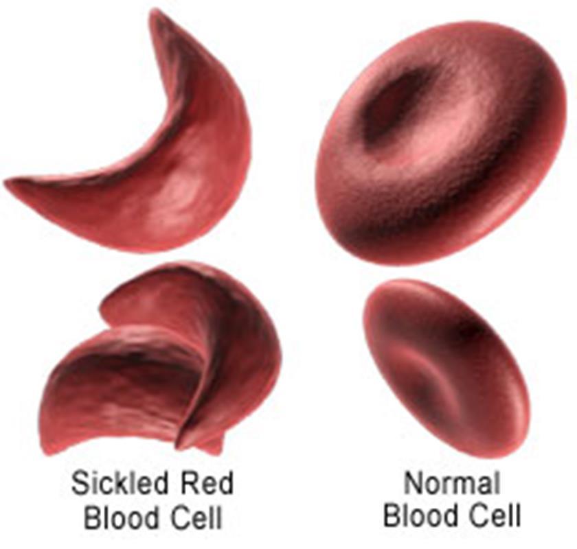 Autosomal Recessive Disorders Sickle Cell Anemia: Condition tends to persist in the population of