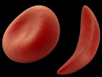 Autosomal Recessive Disorders Sickle Cell Anemia: Condition tends to persist in the population of