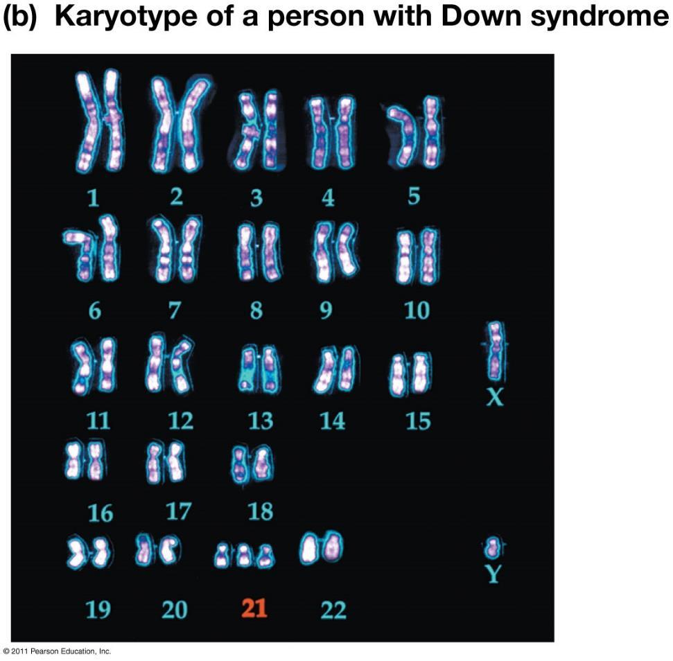 Mistakes during meiosis can produce gametes with abnormal numbers of chromosomes: Normally gametes are haploid or n C. Trisomy 21 1. This is the most common chromosomal abnormality. 2. A person has three copies of chromosome 21.