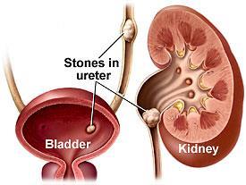 **Kidney stones may form in the renal