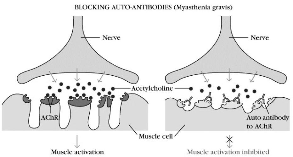 Myasthenia Gravis Blocking Autoantibodies Autoantibodies to surface receptors Blocking autoantibodies Hashimoto's thyroiditis =hypothyroid Blocking autoantibodies inhibit thyroid function.