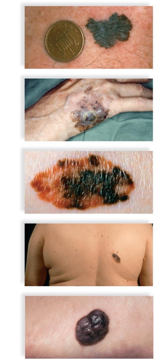20.3 Diagnosis of Cancer Detecting skin cancer Copyright The McGraw-Hill Companies, Inc. Permission required for reproduction or display.
