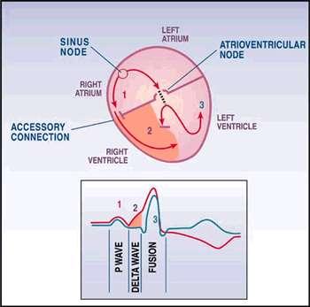Generally, AV conduction through the accessory pathway is faster than through the AV Node.