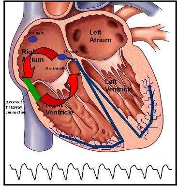 IT S A group of ECG and Electrophysiological abnormalities in which The atrial impulses are conducted partly or completely, PREMATURELY, to the
