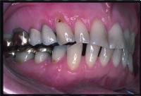 PRACTICE e c d f Fig. 6 to 6f A worn dentition restored with indirect restortions in the posterior qudrnts posterior qudrnts.