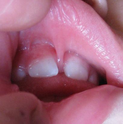 Dental Diastema Dental Diastema Orthodontic