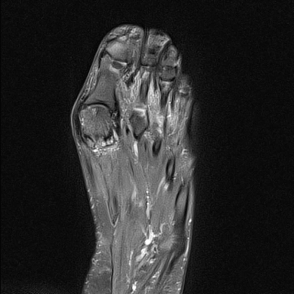 Fig. 1: The coronal fat sat PD-WI of the forefoot shows hallux valgus, atricular cartilage defects