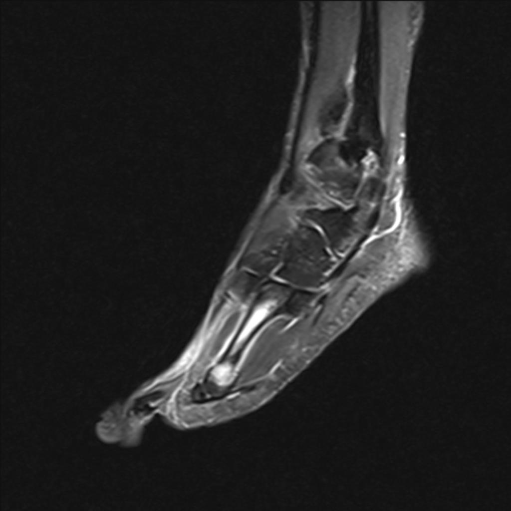 Fig. 4: The sagittal contrast enhanced fat sat T1-WI of the forefoot depicts diffuse edema of the fourth