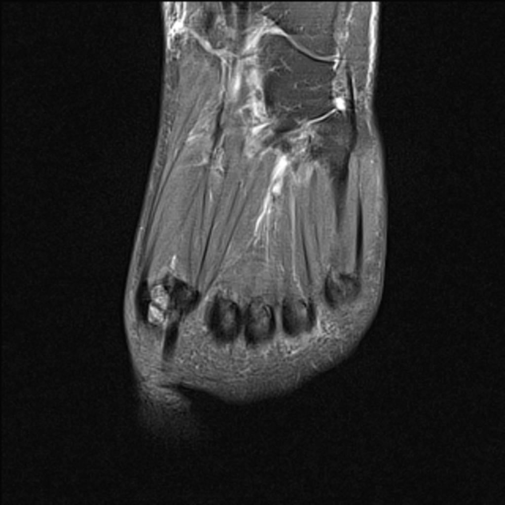 Fig. 5: The coronal fat sat PD-WI of the forefoot shows bipartite medial sesamoid