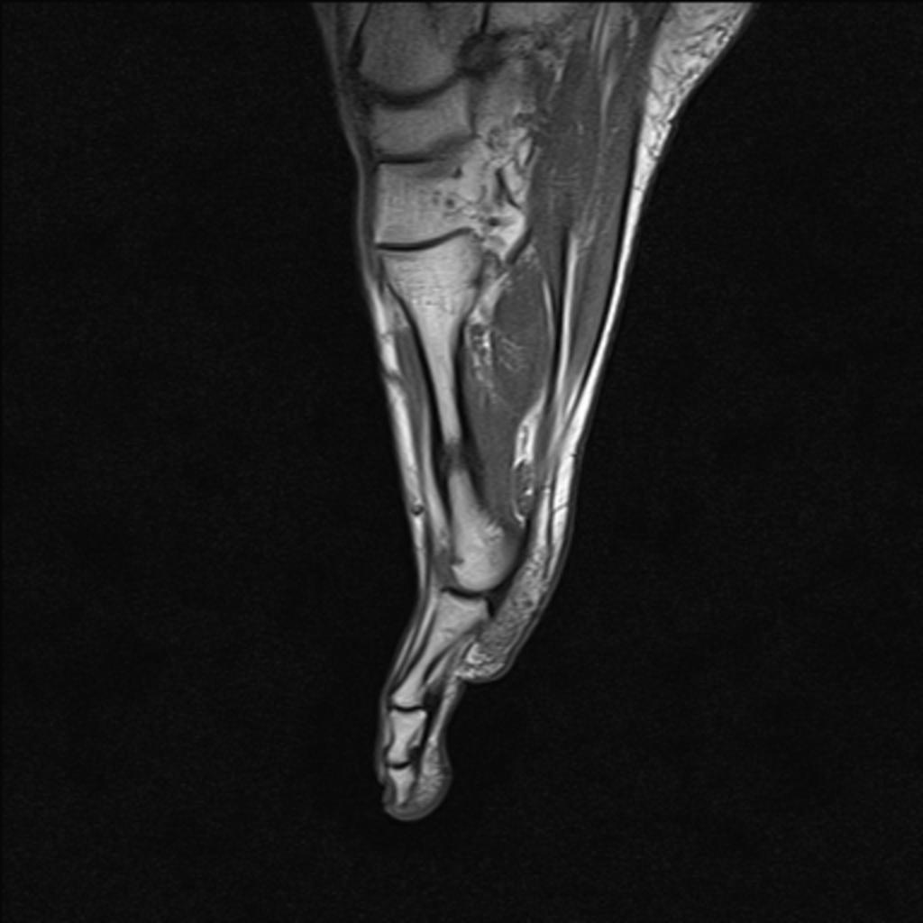 Fig. 7: The sagittal T1-WI of the forefoot depicts hypointense linear area in the distal third of the second
