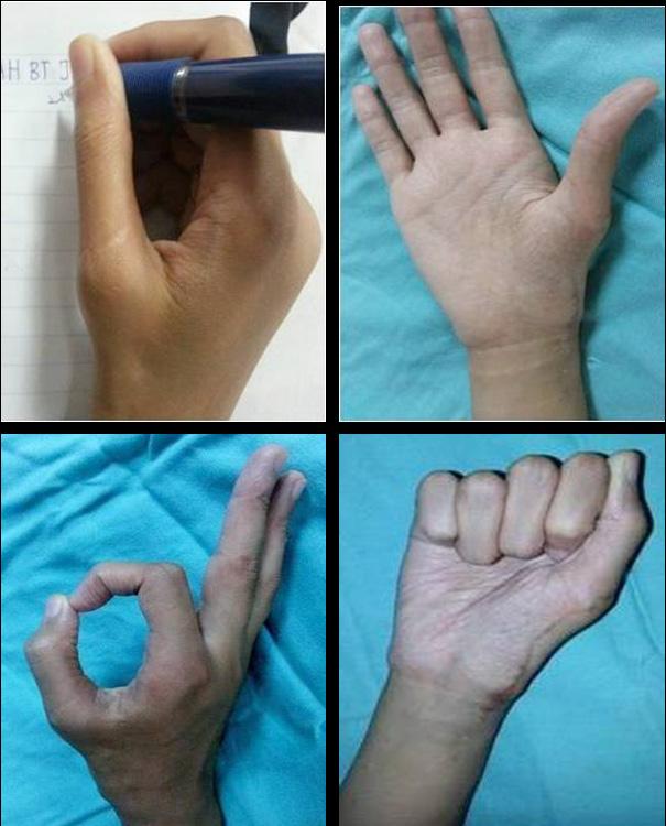 IMJM THE INTERNATIONAL MEDICAL JOURNAL Malaysia Figure 4. Normal hand function at two years post-surgery.