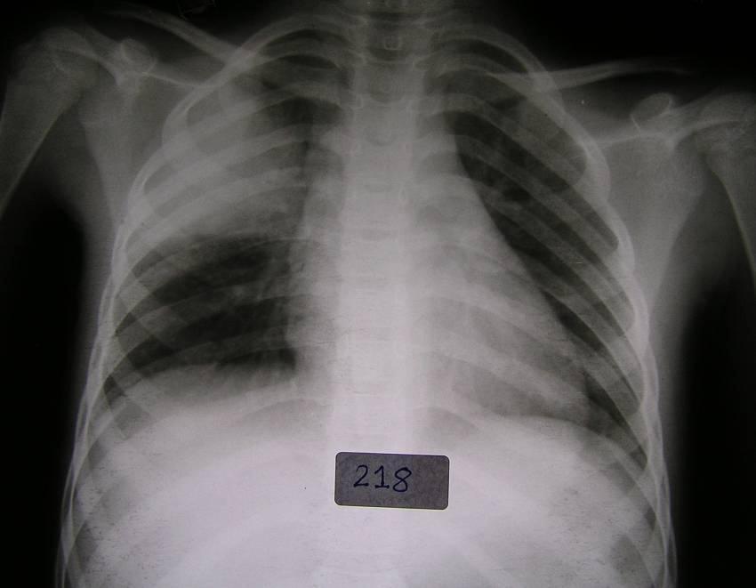 Fundamental Issues in Determining Pneumonia Aetiology (1) Specimen collection Difficulty in