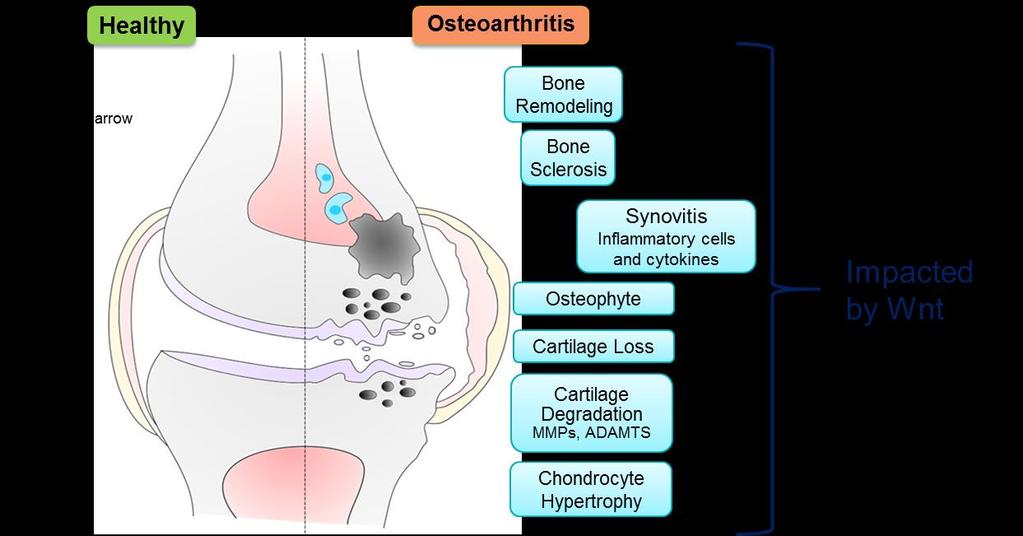 The Wnt pathway, osteoarthritis (OA), and inflammation Increased Wnt signaling drives bone formation, cartilage breakdown, and inflammation 1-4 Wnt pathway mutations (e.g., FrzB, DOT1L) are associated with OA 5,6 Wnt proteins are over-expressed in OA joints 7,8 1.