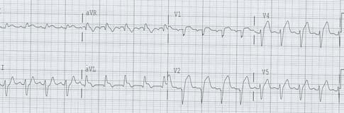54 year old male with midsternal chest pain x 2 hours 9/10 History of meth use, family history of CAD Cardiac Level I activation?