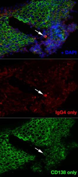 Supplementary Figure 3. There is a single IgG4 plasma cell in the subepithelial lamina propria (arrow).