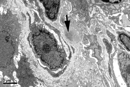 Supplementary Figure 4. Electron microscopy of esophageal stroma from an eosinophilic esophagitis subject.