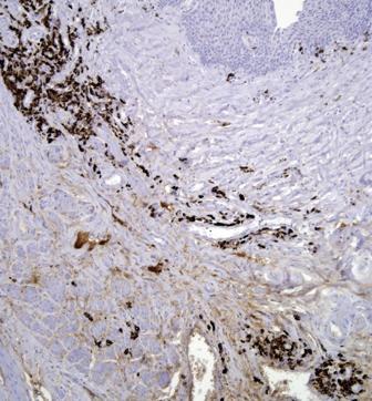 Esophagectomy IgG4 immunostain at low power, showing that the majority of the plasma cells are in the deep lamina propria at top left and bottom