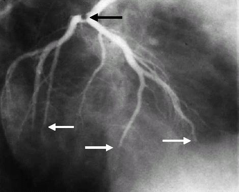 Impact of Macroscopic Distal Emboli DE occurred in 27 of 178 (15%) pts after primary PTCA ST res Infarct size