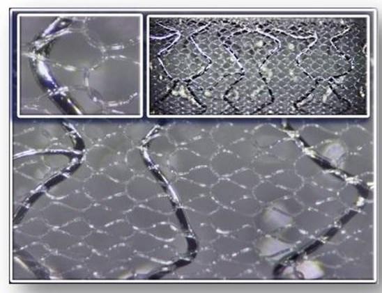 The MGuard Coronary Stent System A stent wrapped with ultra-thin (20μm) polymer mesh sleeve.