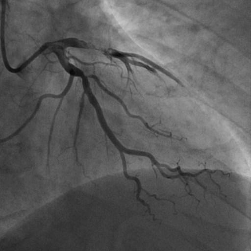 The Goal of Primary PCI in STEMI Restore flow in the culprit artery and optimize myocardial