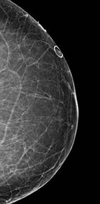 To get a better look at dense breast tissue, our screening protocol is a Digital Breast Tomosynthesis mammogram supplemented by an Automated Breast Ultrasound (ABUS).
