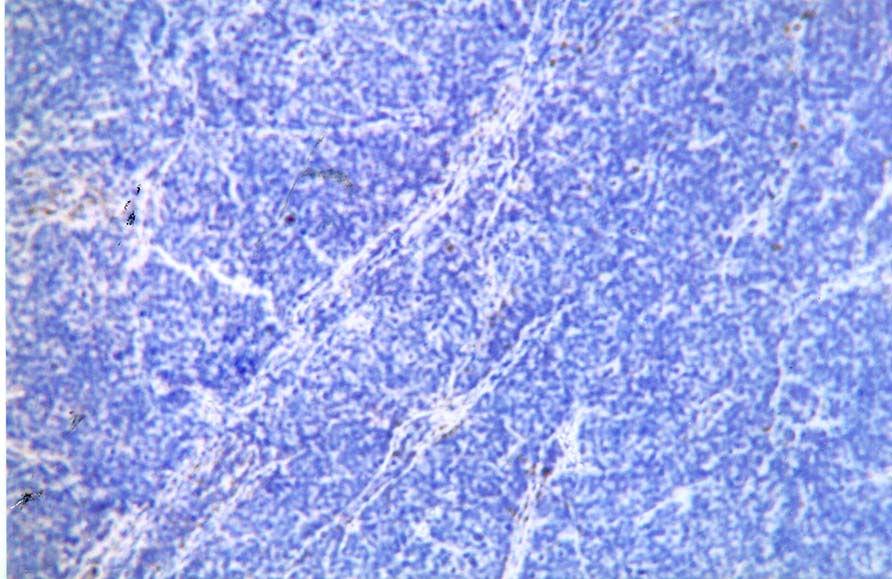Neuroendocrine carcinoma of the posterior mediastinum; (negative immunohistochemical reaction to CD-99, x 400) Slika