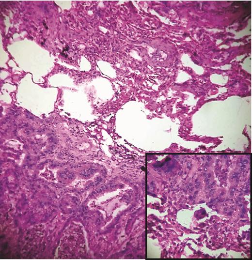 Figure 8: Squamous cell carcinoma Lung with