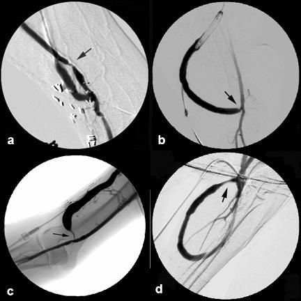 1.2.6 Arterial Angioplasty In considering the vascular component of an arteriovenous access, the arterial anastomosis should be classified as arterial.