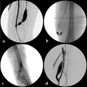Fistula Case 10 Fistula and Anastomotic Stenosis Referral: Failure for fistula to develop and poor flow History: 44 year old female Brachial-cephalic fistula Two year old Poor flow Physical