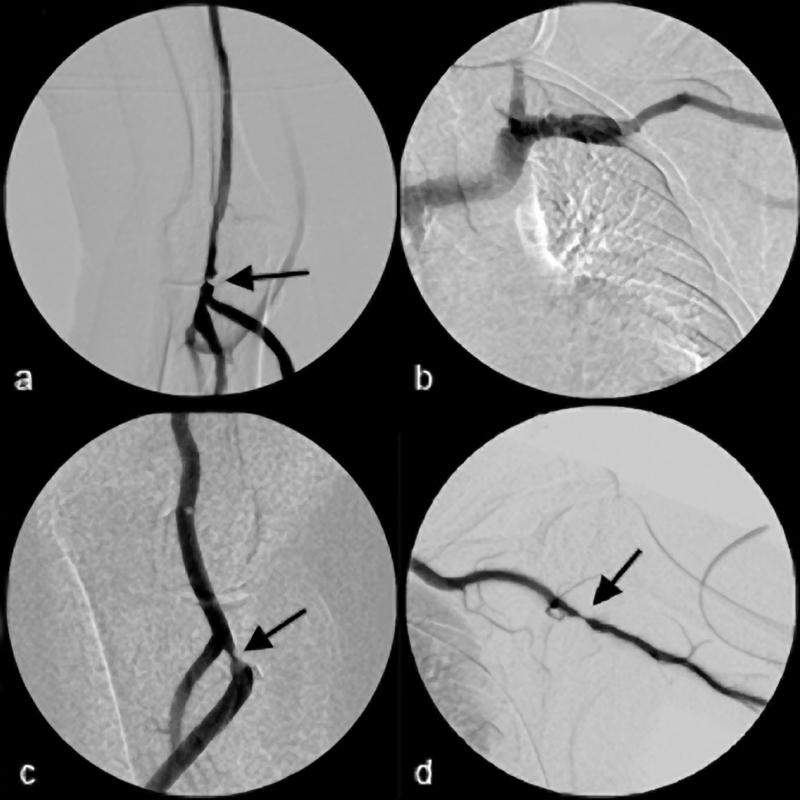 Graft Case 2 Angioplasty of Graft (Multiple Arterial Angioplasties) Referral: Poor flow.