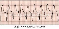 Ventricular Tachycardia 3 or more PVC with rate >100 bpm-