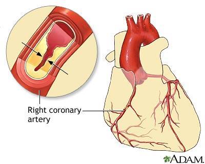 CAD Overtime, build-up of plaque can lead to arterial occlusion, which can cause a devastating blockage which will decrease or cut off oxygen