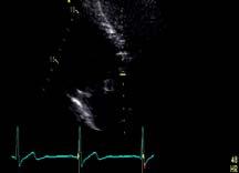 76 m/s Correct sample placement PFV LVOT 1.